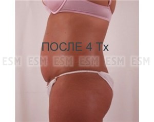 Аппарат для коррекции фигуры Exilis BTL _1